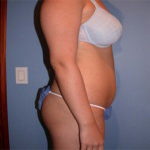Patient # 82754 Before Photo # 3