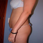 Patient # 82754 Before Photo # 5