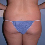Patient # 82754 Before Photo # 7