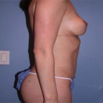 Patient # 81416 After Photo # 4