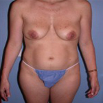 Patient # 81416 Before Photo # 1