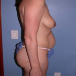 Patient # 81416 Before Photo # 3