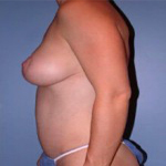 Patient # 31639 After Photo # 4