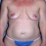 Patient # 31639 Before Photo # 1