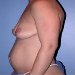 Patient # 31639 Before Photo # 3