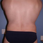 Patient # 80371 After Photo # 4