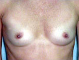 Patient # 85401 Before Photo # 1