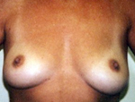 Patient # 90847 Before Photo # 1