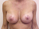 Patient # 54363 After Photo # 2
