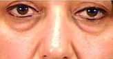 Patient # 81999 Before Photo # 1
