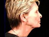 Patient # 24337 Before Photo # 3