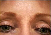 Patient # 29476 Before Photo # 1