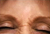 Patient # 29476 Before Photo # 3