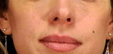 Patient # 40887 After Photo # 2