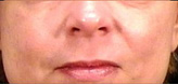 Patient # 23226 After Photo # 2