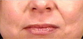 Patient # 23226 Before Photo # 1