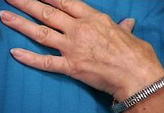 Patient # 59056 Before Photo # 3