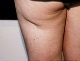 Patient # 85953 Before Photo # 1
