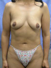Patient # 58803 Before Photo # 1