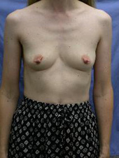 Patient # 86488 Before Photo # 1