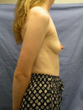 Patient # 86488 Before Photo # 3