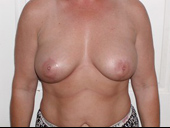 Patient # 30956 After Photo # 2