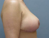 Patient # 84991 After Photo # 4