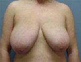 Patient # 84991 Before Photo # 1