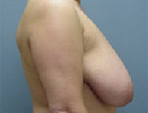 Patient # 84991 Before Photo # 3