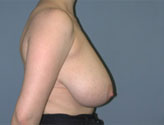 Patient # 13777 Before Photo # 3