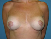 Patient # 90625 After Photo # 2
