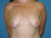 Patient # 90625 Before Photo # 1