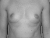 Patient # 68803 Before Photo # 1