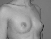 Patient # 68803 Before Photo # 3