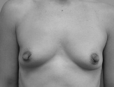 Patient # 36398 Before Photo # 1