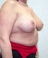 Patient # 18786 After Photo # 4