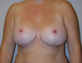 Patient # 48032 After Photo # 2