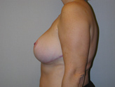 Patient # 48032 After Photo # 6