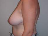 Patient # 48032 Before Photo # 5