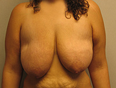 Patient # 32279 Before Photo # 1