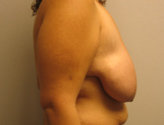 Patient # 32279 Before Photo # 3