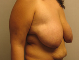 Patient # 32279 Before Photo # 5