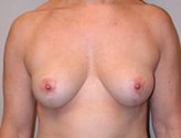 Patient # 78986 After Photo # 2