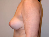Patient # 78986 After Photo # 6