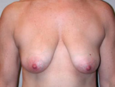 Patient # 78986 Before Photo # 1