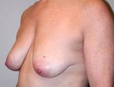 Patient # 78986 Before Photo # 3