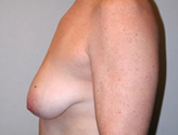 Patient # 78986 Before Photo # 5