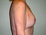 Patient # 10255 After Photo # 6