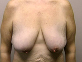 Patient # 10255 Before Photo # 1