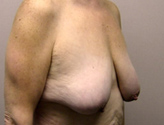 Patient # 10255 Before Photo # 3